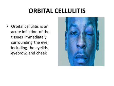 ORBITAL CELLULITIS Orbital cellulitis is an acute infection of the tissues immediately surrounding the eye, including the eyelids, eyebrow, and cheek.
