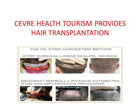 CEVRE HEALTH TOURISM PROVIDES HAIR TRANSPLANTATION.