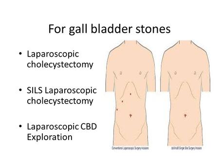 For gall bladder stones