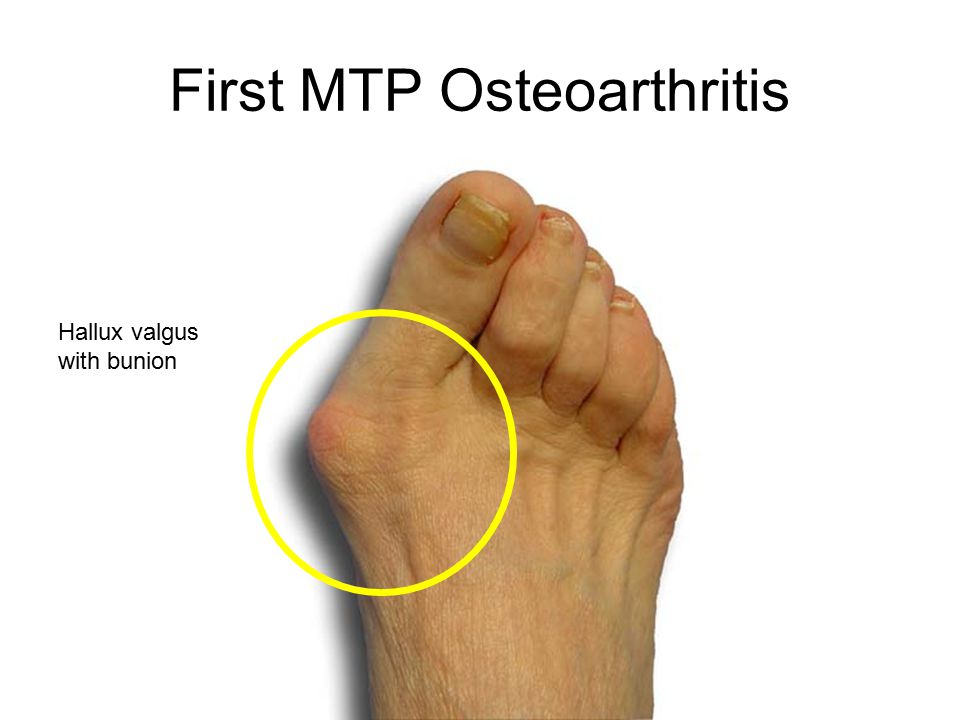 mild bilateral first mtp osteoarthritis