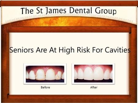 Seniors Are At High Risk For Cavities BeforeAfter.