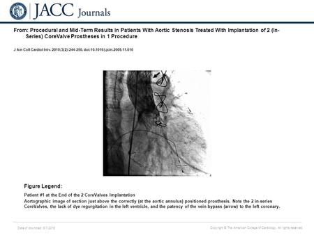 Date of download: 6/7/2016 Copyright © The American College of Cardiology. All rights reserved. From: Procedural and Mid-Term Results in Patients With.