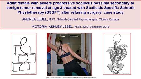 Adult female with severe progressive scoliosis possibly secondary to benign tumor removal at age 3 treated with Scoliosis Specific Schroth Physiotherapy.