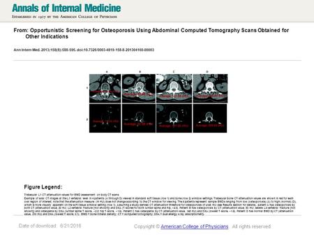 Date of download: 6/21/2016 From: Opportunistic Screening for Osteoporosis Using Abdominal Computed Tomography Scans Obtained for Other Indications Ann.