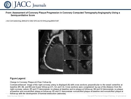 Date of download: 6/22/2016 Copyright © The American College of Cardiology. All rights reserved. From: Assessment of Coronary Plaque Progression in Coronary.
