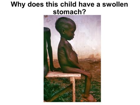 Why does this child have a swollen stomach?. L3: Unbalanced Diet and Deficiencies Lesson Objectives: All students must: Describe some health issues caused.