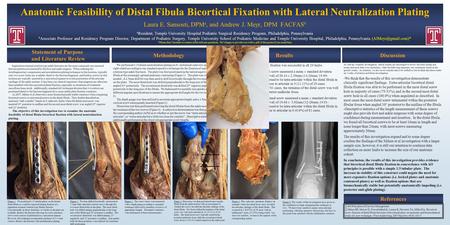 Anatomic Feasibility of Distal Fibula Bicortical Fixation with Lateral Neutralization Plating Laura E. Sansosti, DPM a, and Andrew J. Meyr, DPM FACFAS.