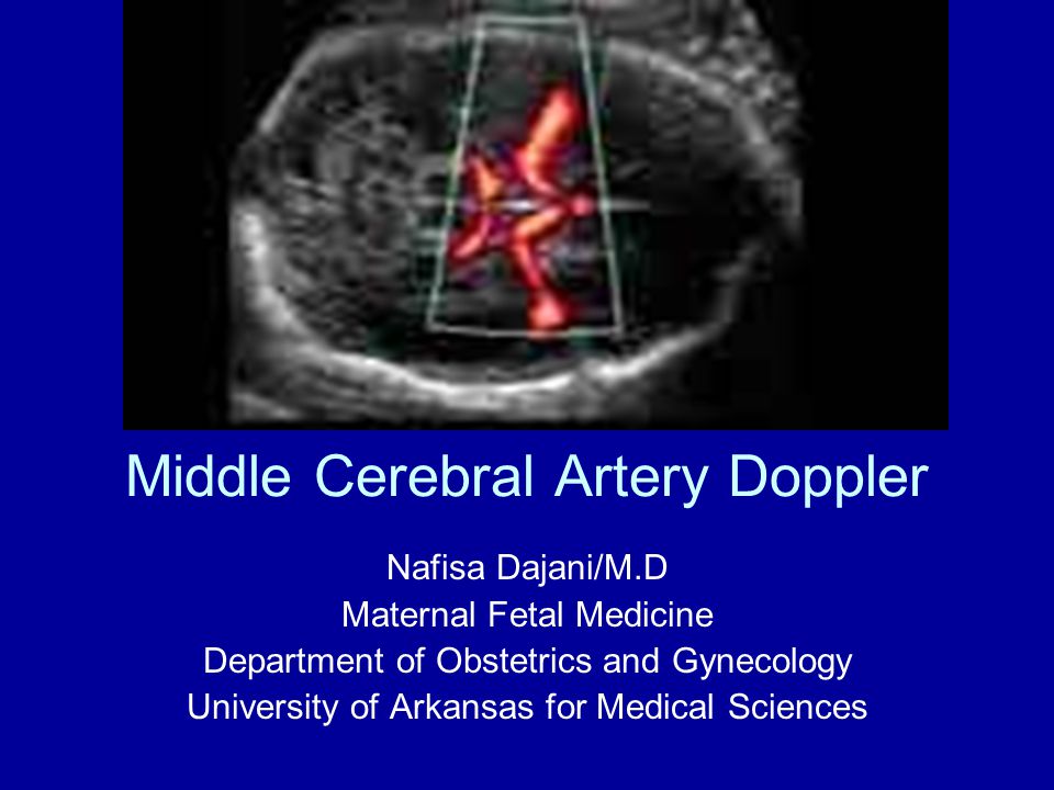 Middle Cerebral Artery Doppler - ppt video online download