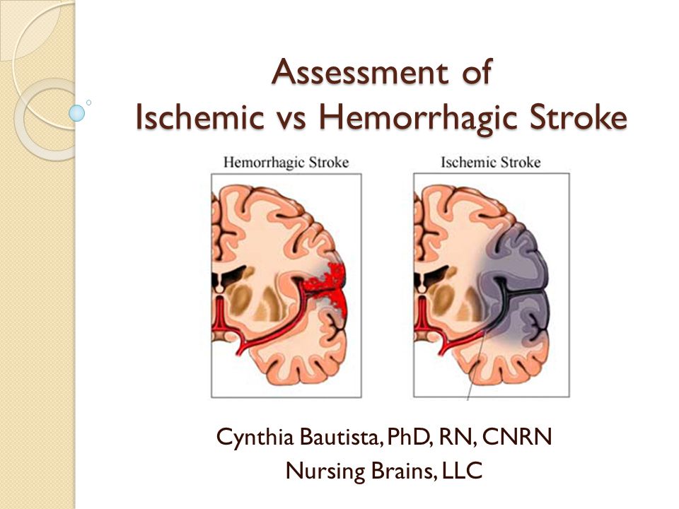 ischemic stroke vs hemorrhagic stroke