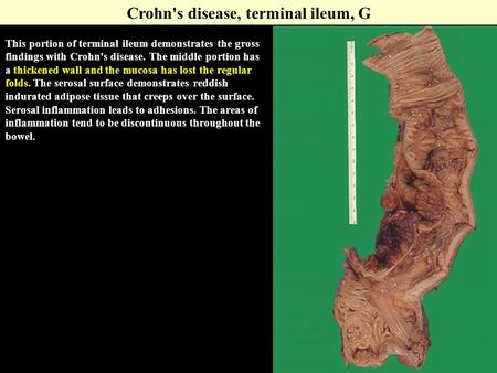 Crohn's disease, terminal ileum, G