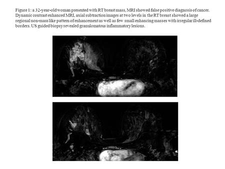 Figure 1: a 32-year-old woman presented with RT breast mass, MRI showed false positive diagnosis of cancer. Dynamic contrast enhanced MRI, axial subtraction.