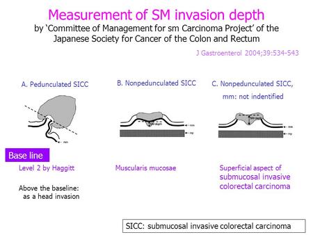 Measurement of SM invasion depth by ‘Committee of Management for sm Carcinoma Project’ of the Japanese Society for Cancer of the Colon and Rectum J Gastroenterol.