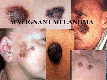 MALIGNANT MELANOMA. Outline Introduction Aetiology Types Invasion and Metastasis Risk Factors Diagnosis and Staging Treatment and Prevention.