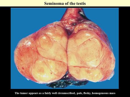 The tumor appears as a fairly well circumscribed, pale, fleshy, homogeneous mass Seminoma of the testis.
