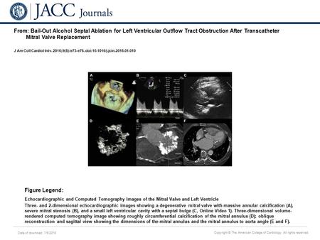 Date of download: 7/6/2016 Copyright © The American College of Cardiology. All rights reserved. From: Bail-Out Alcohol Septal Ablation for Left Ventricular.