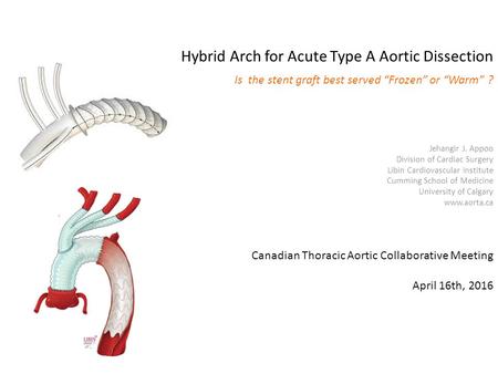 Hybrid Arch for Acute Type A Aortic Dissection