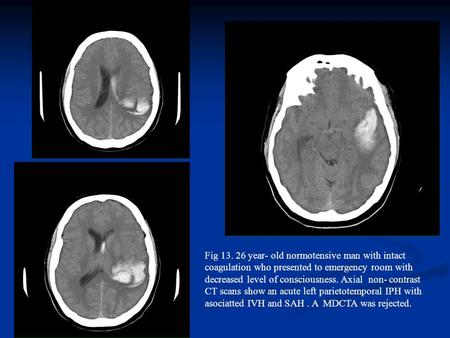 Fig 13. 26 year- old normotensive man with intact coagulation who presented to emergency room with decreased level of consciousness. Axial non- contrast.