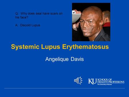Systemic Lupus Erythematosus Angelique Davis Q: Why does seal have scars on his face? A: Discoid Lupus.