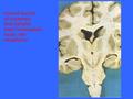 Coronal section of brainstem, diencephalon,