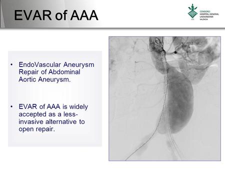 EVAR of AAA EndoVascular Aneurysm Repair of Abdominal Aortic Aneurysm.