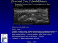 Ultrasound Case: Cuboidal Bursitis