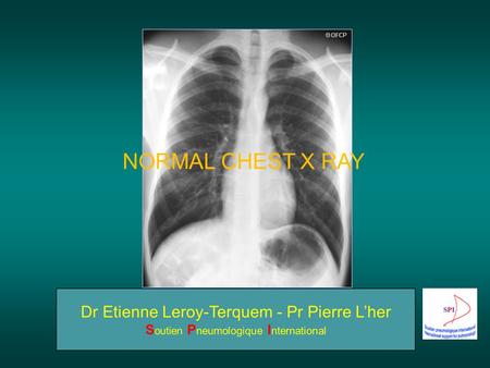 NORMAL CHEST X RAY.