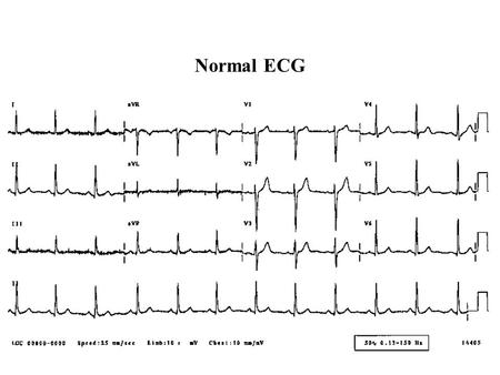 Normal ECG Normal adult 12-lead ECG