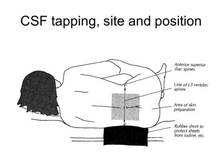 CSF tapping, site and position. Method of lumbar puncture 1) Carried out between L3-4 or L4-5 interspace located by the level of the iliac crest 2)