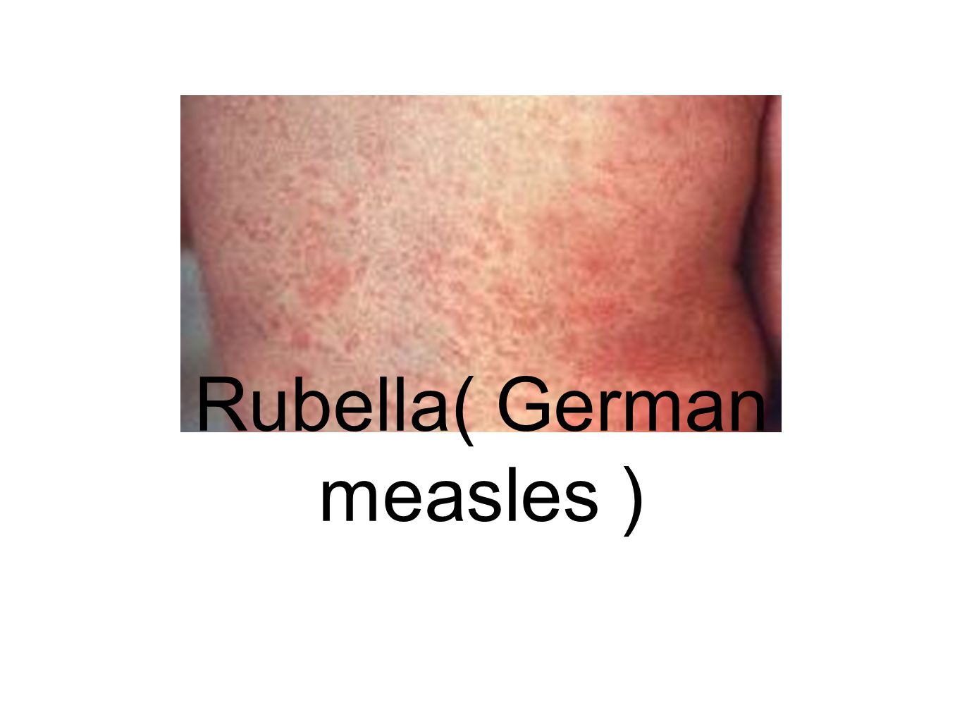 German Measles