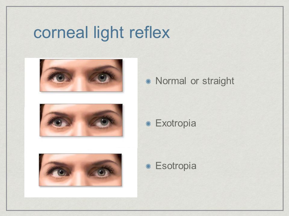 Fresh 70 of Corneal Light Reflex Normal