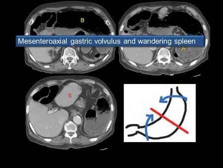 A A P B S Mesenteroaxial gastric volvulus and wandering spleen.