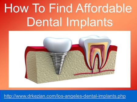 How To Find Affordable Dental Implants