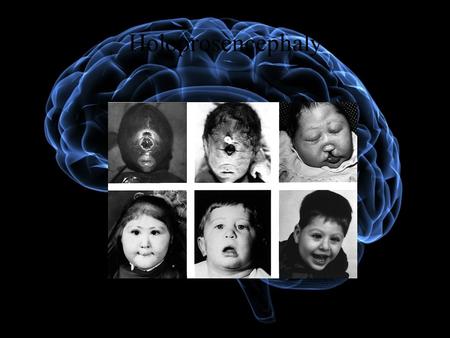 Holoprosencephaly. What is Holoprosencephaly? ● Holoprosencephaly, according to the National Human Genome Institute (2009), is a common birth defect affecting.