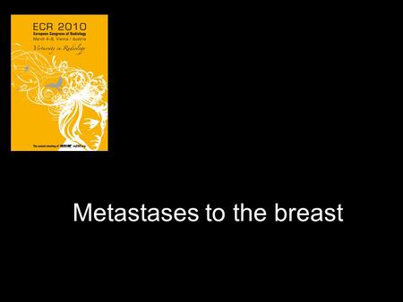 Metastases to the breast. 49-year-old woman Palpable lump in the left breast.