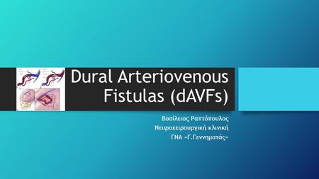 Dural Arteriovenous Fistulas (dAVFs) Βασίλειος Ραπτόπουλος Νευροχειρουργική κλινική ΓΝΑ «Γ.Γεννηματάς»