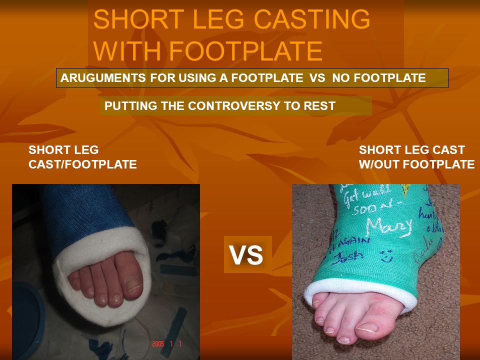 SHORT LEG CASTING WITH FOOTPLATE - ppt download