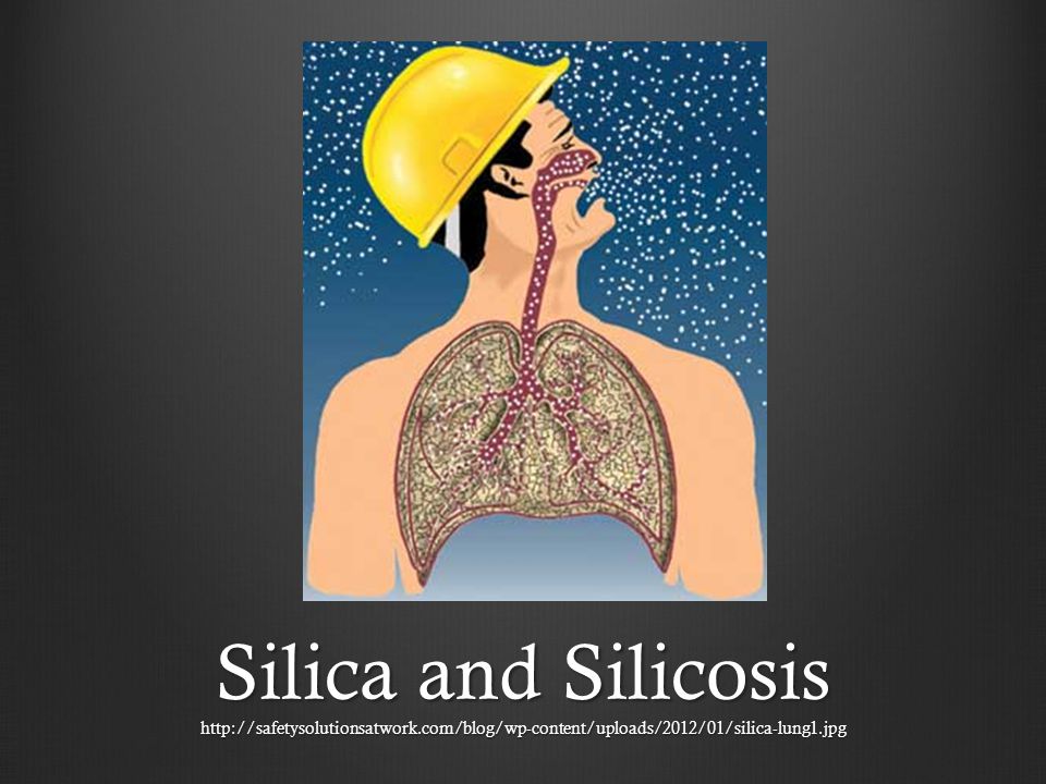 Lung disease caused by silica dust
