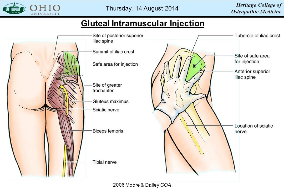 superior gluteal nerve injection