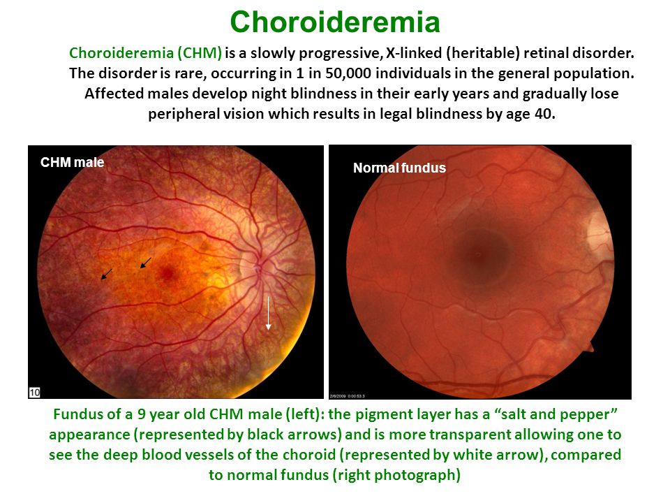 Fundus of a 9 year old CHM male (left): the pigment layer has a “salt and  pepper” appearance (represented by black arrows) and is more transparent  allowing. - ppt download