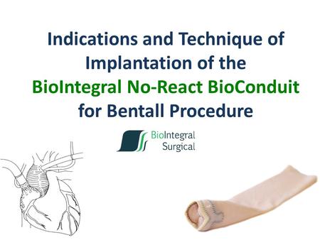 Indications and Technique of Implantation of the BioIntegral No-React BioConduit for Bentall Procedure.