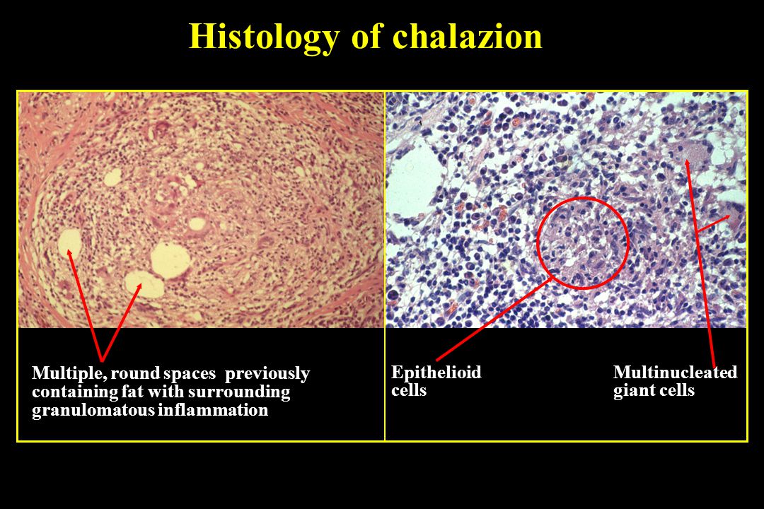 Molluscum contagiosum - ppt video online download