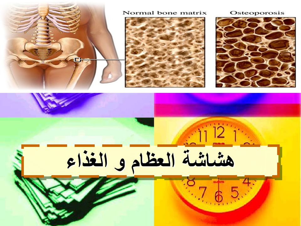 هشاشه العظام اسبابه واعراضه وعلاجه موضوع شامل ومبسط Youtube