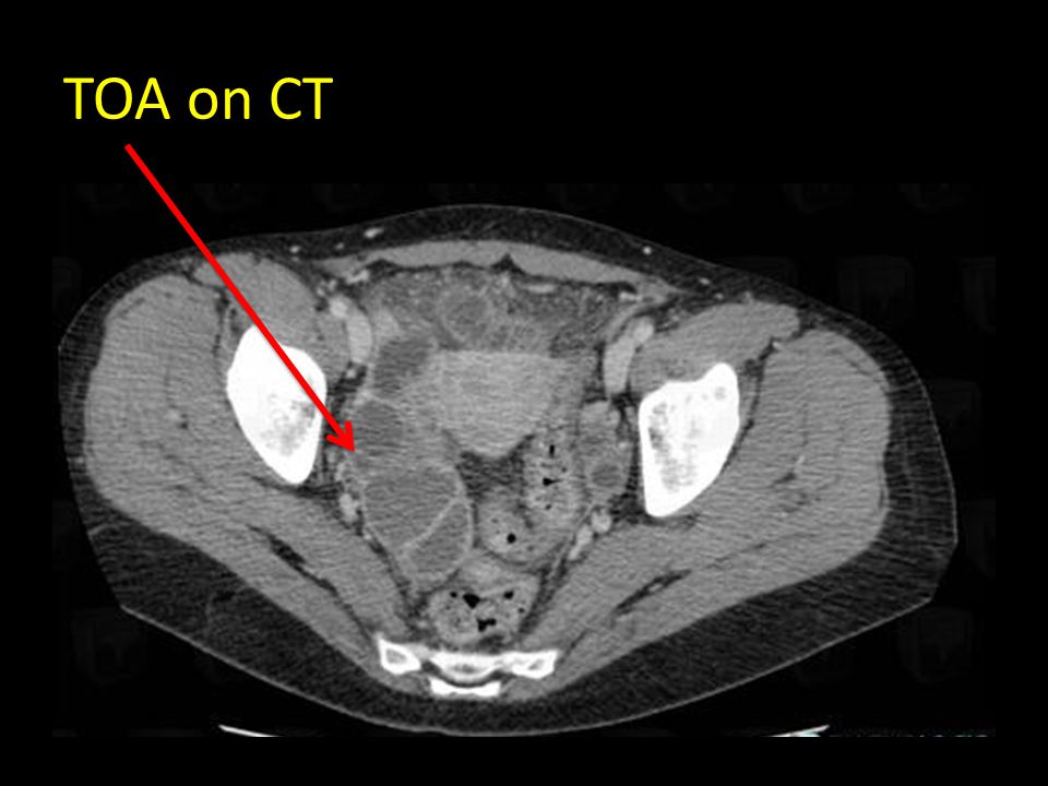 TOA+on+CT