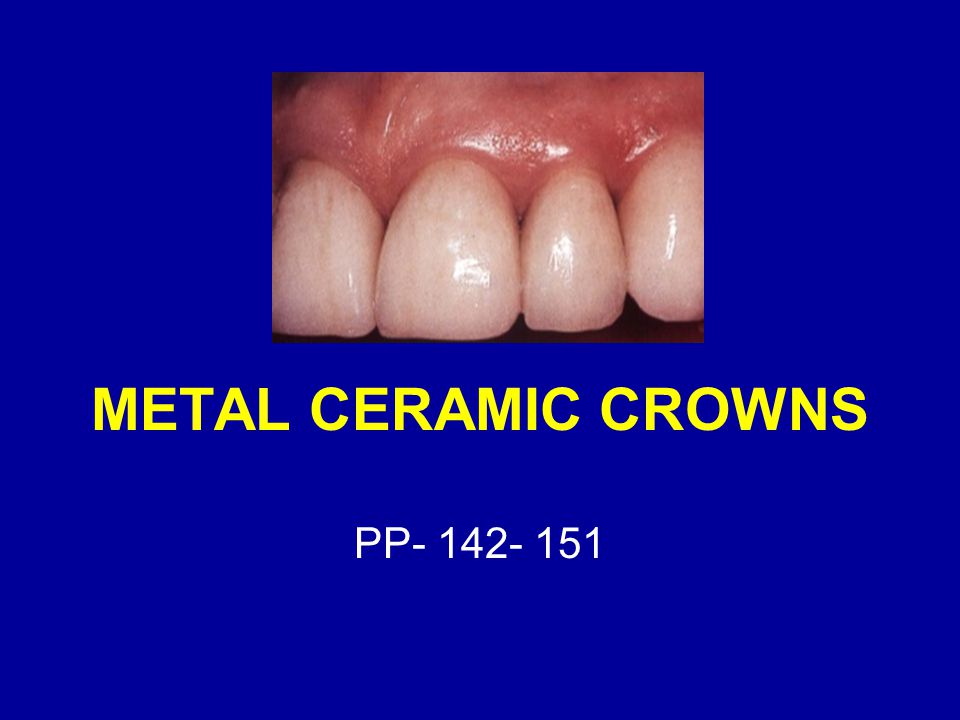 METAL CERAMIC CROWNS PP ppt video online download