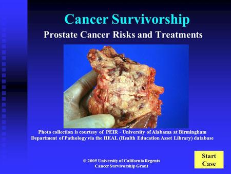 Prostate Cancer Risks and Treatments