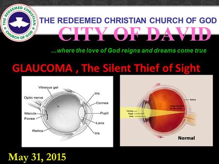 THE REDEEMED CHRISTIAN CHURCH OF GOD CITY OF DAVID...where the love of God reigns and dreams come true GLAUCOMA, The Silent Thief of Sight May 31, 2015.