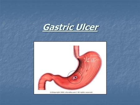 Gastric Ulcer. Even though gastric ulcer is a common disease, a diagnosis can be difficult because it has a wide spectrum of clinical presentations, ranging.