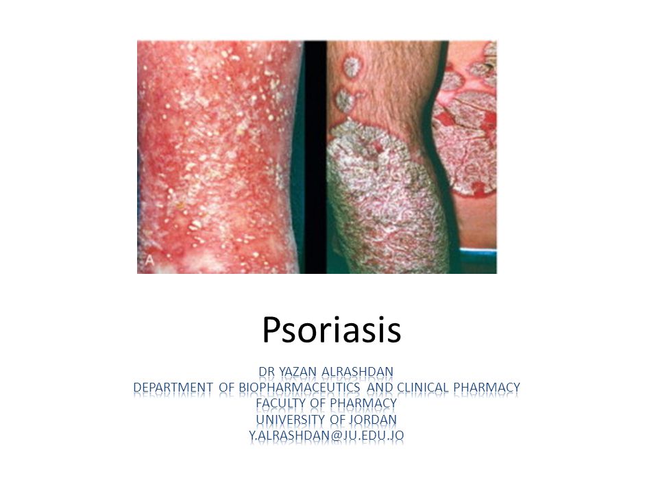 psoriasis disease classification megszabadulni a pikkelysömörtől szódával