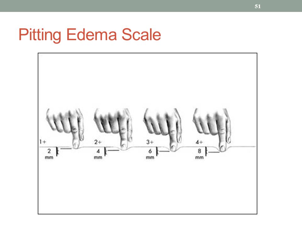 Pitting Edema Scale 1 4 | www.imgkid.com - The Image Kid Has It!