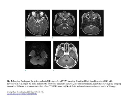 Fig. 2. Imaging findings of the lesion on brain MRI